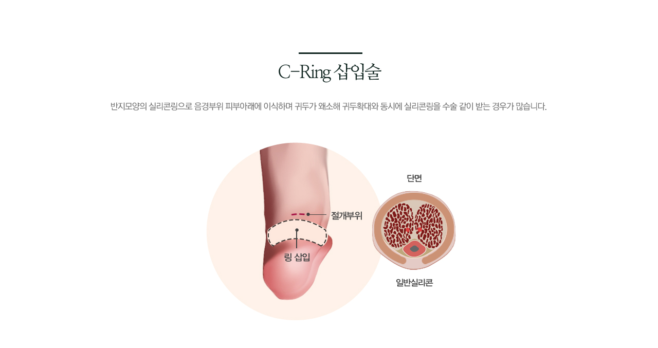 C-Ring 삽입술