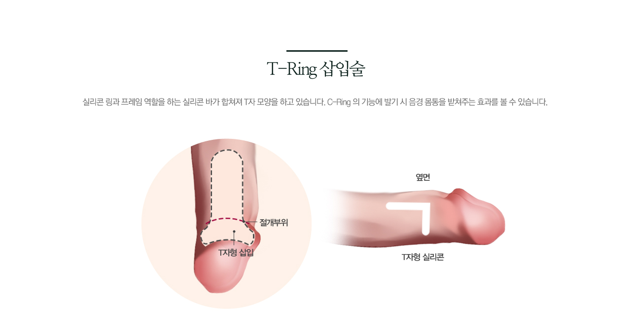 T-Ring 삽입술