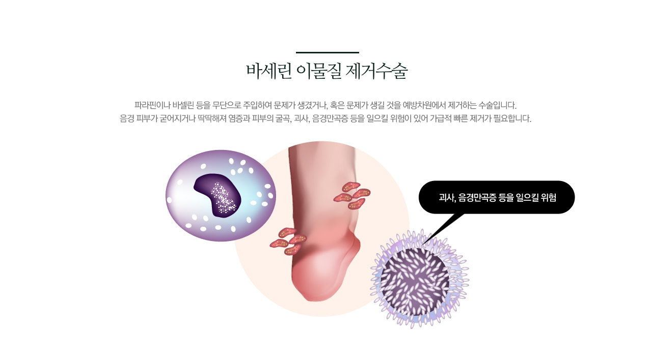 바세린 이물질 제거수술