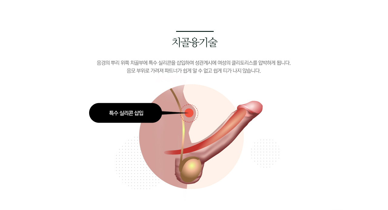 치골 융기술