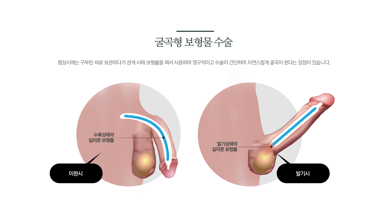 굴곡형 보형물 수술