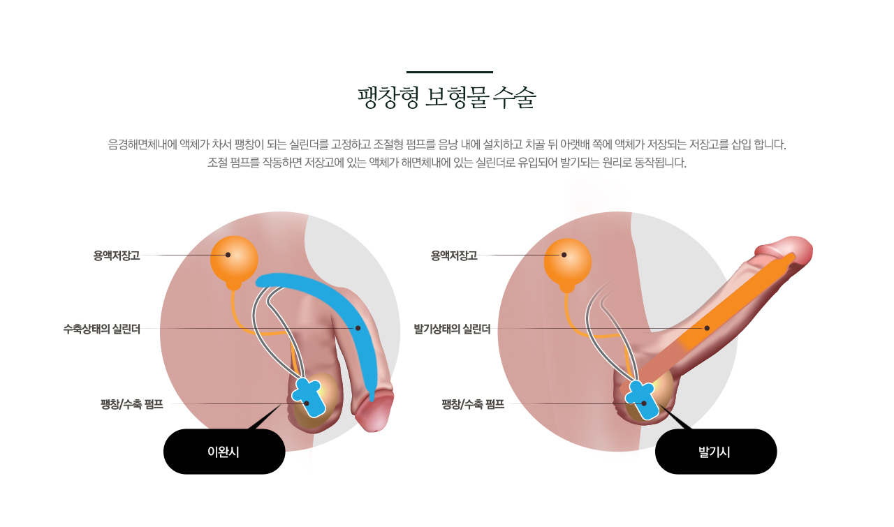 팽창형 보형물 수술